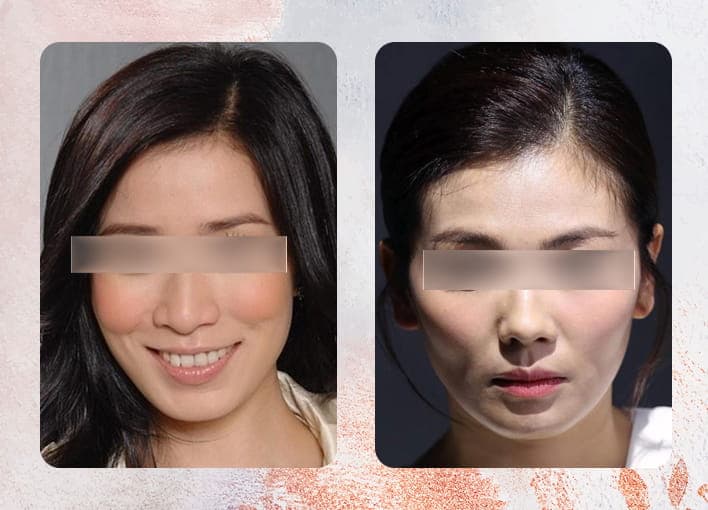 顴骨插入天倉與婚姻關聯